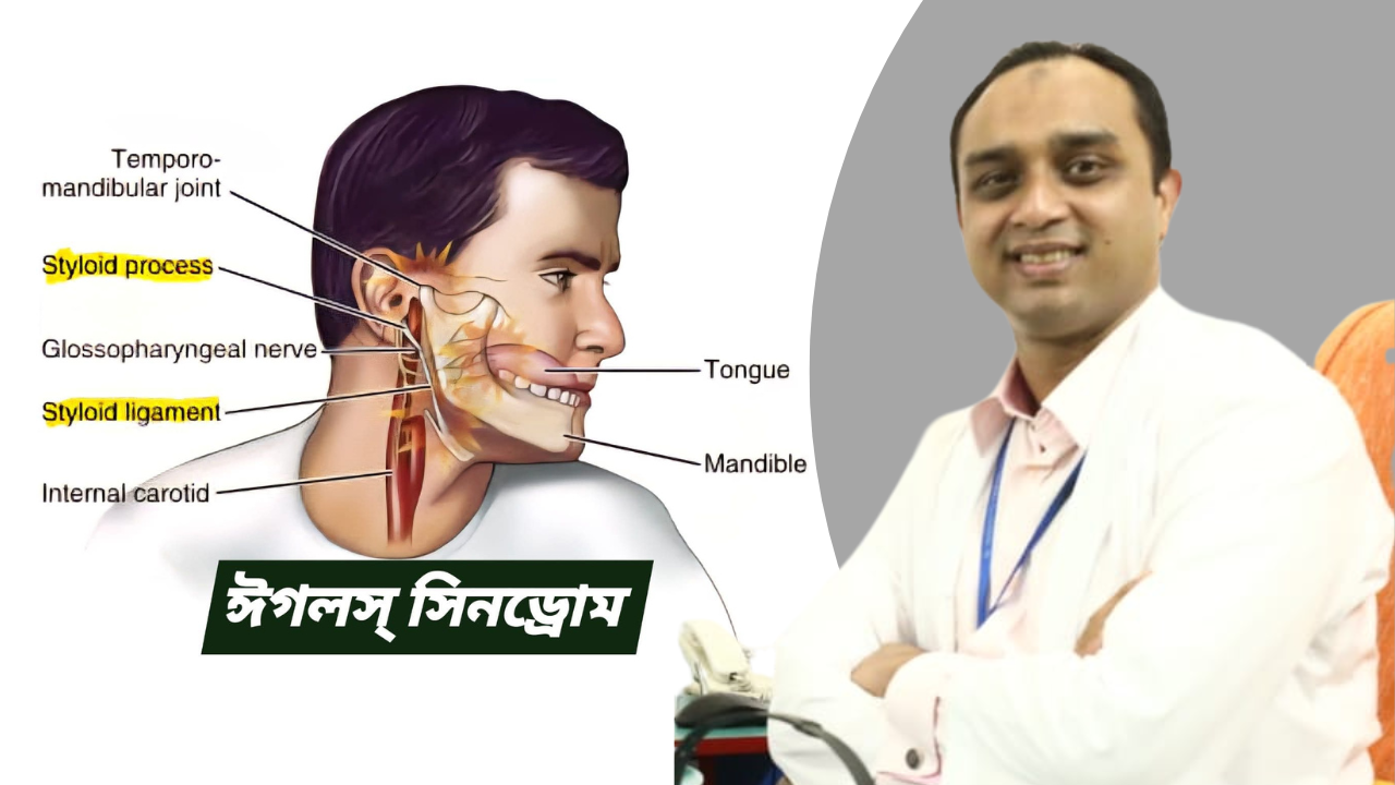 ইগলস সিনড্রোম (Eagle’s Syndrome): ঘাড় ও গলার ব্যথার এক অজানা কারণ